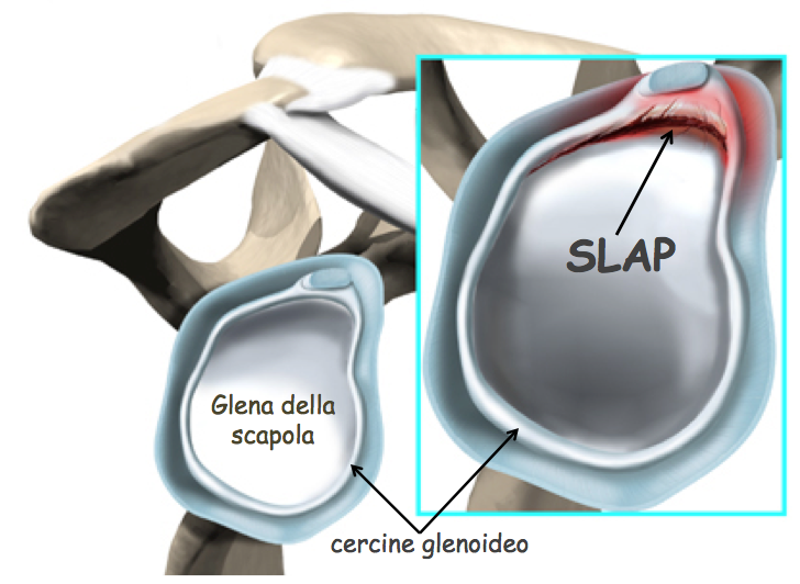 Le Lesioni SLAP Della Spalla